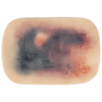 TraumaSim Self-Adhesive Large Haematoma