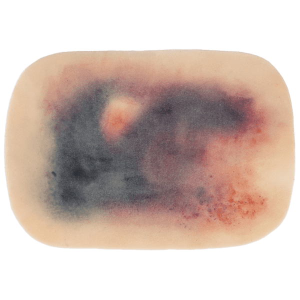 TraumaSim Self-Adhesive Large Haematoma